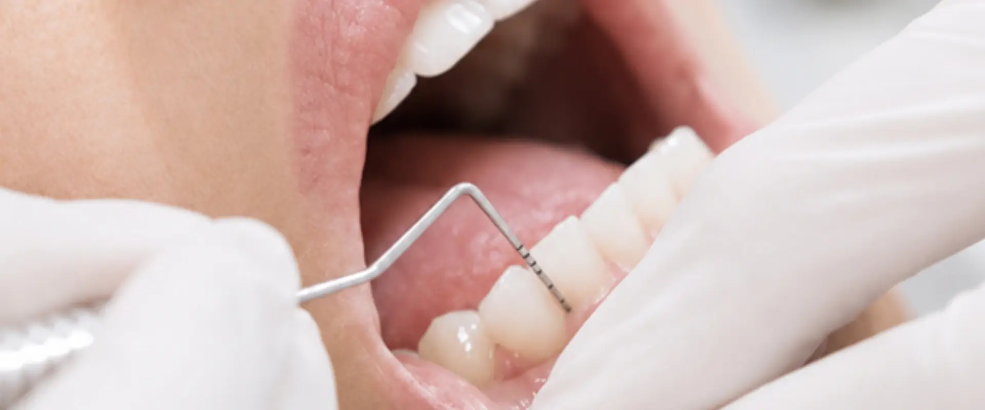 Dental Fillings at Angus Dentistry