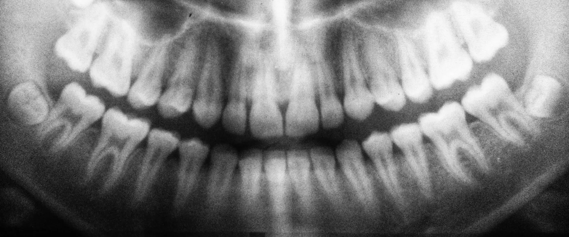 Frenectomy at angus dentistry