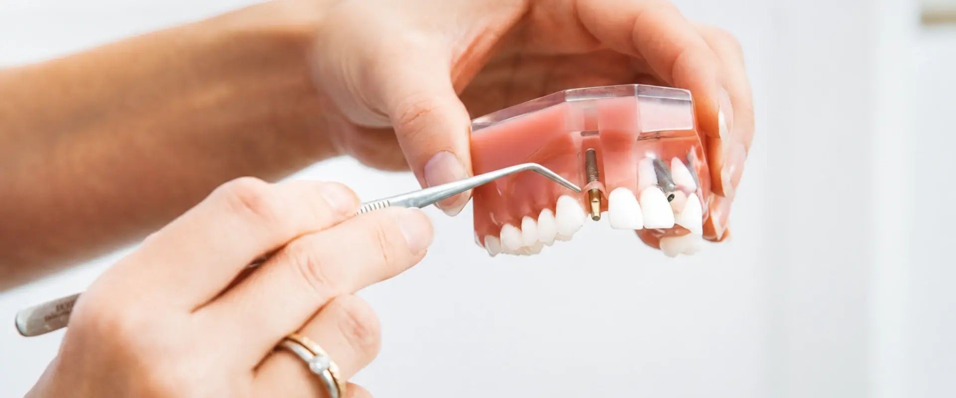 Implant Dentures at Angus Dentistry