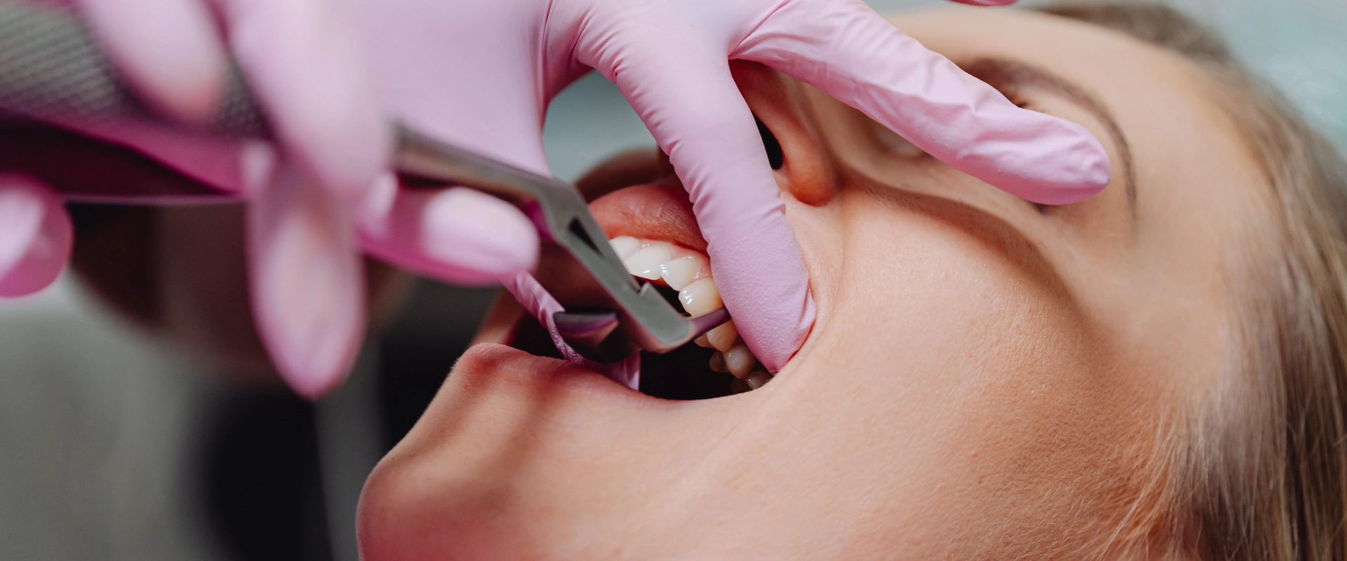 Tooth Extraction in Midlothian, VA