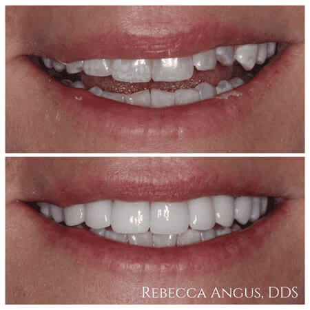 Before and after veneers