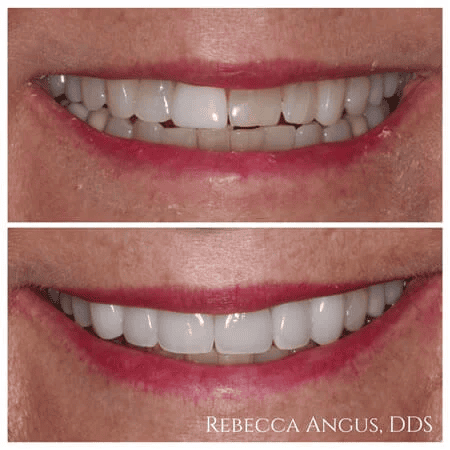 Before and after veneers