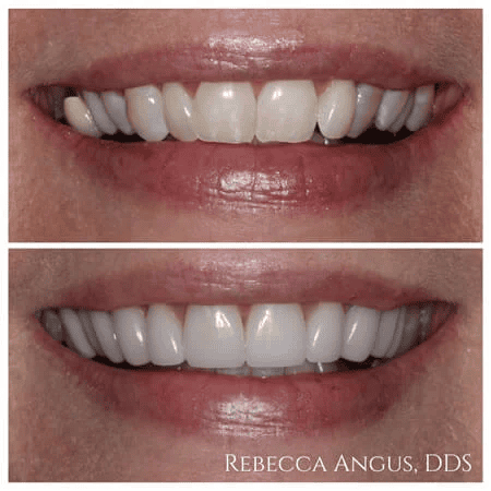 Before and after veneers