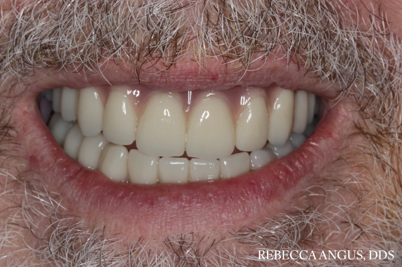 Restored smile with full-arch teeth supported by six dental implants after treatment