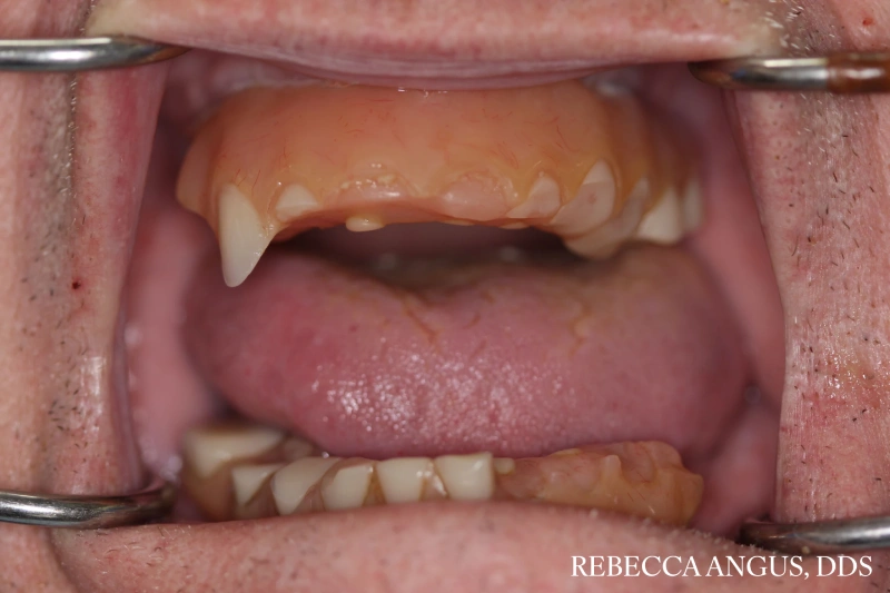 Mouth showing extensive tooth loss before All-on-6 dental implant treatment