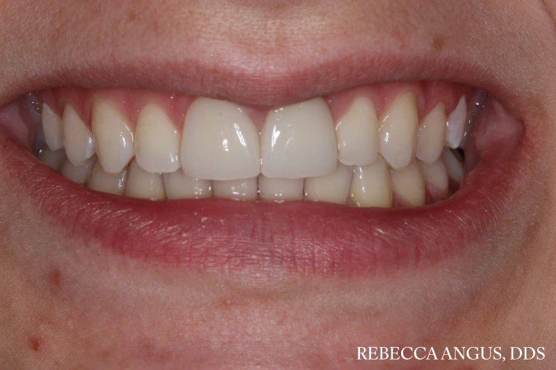 After front tooth dental crowns.