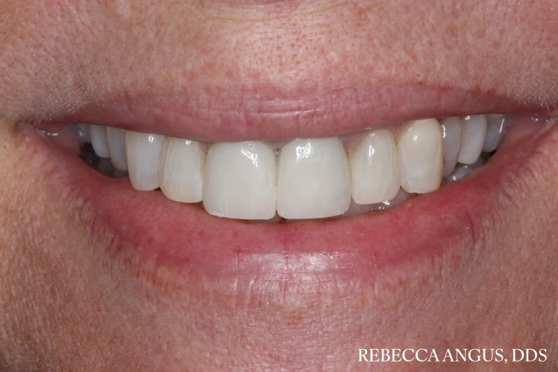 Smile showing new, natural-looking dental crowns on the upper front teeth after treatment
