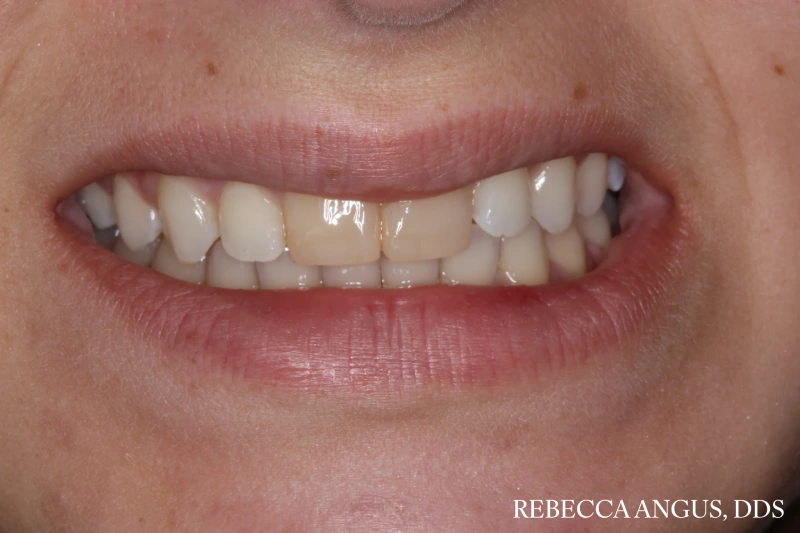 Before front tooth dental crowns.