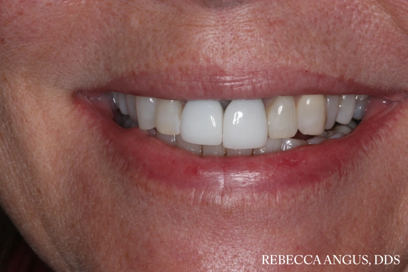 Smile showing older dental crowns on the upper front teeth before treatment
