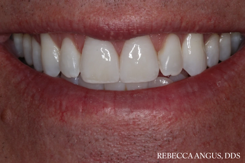 Smile showing brighter, evenly shaped front teeth after porcelain veneers