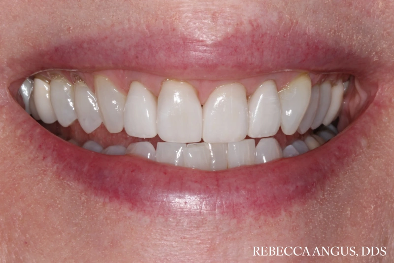 Smile showing brighter, evenly shaped upper front teeth after porcelain veneers