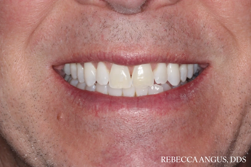 Smile showing uneven spacing and tooth shape before veneers