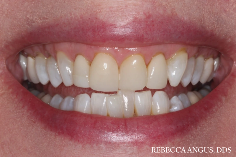 Smile showing discolored and uneven upper front teeth before porcelain veneers