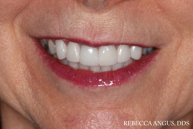 Brighter, more uniform smile after full mouth rehabilitation
