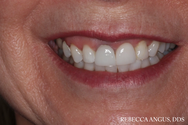 Smile showing uneven tooth shape and color before full mouth rehabilitation